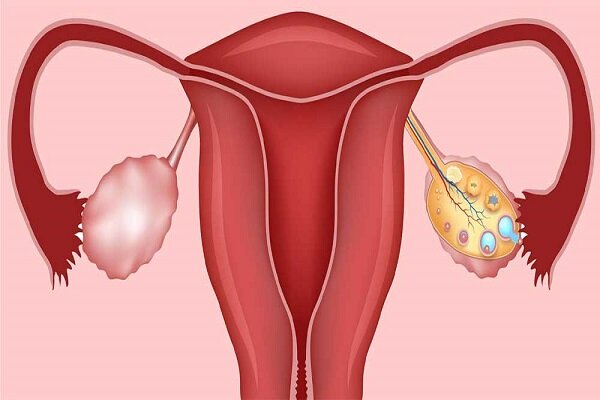 مواد غذایی مضر و مفید برای درمان تخمدان پلی‌کیستیک