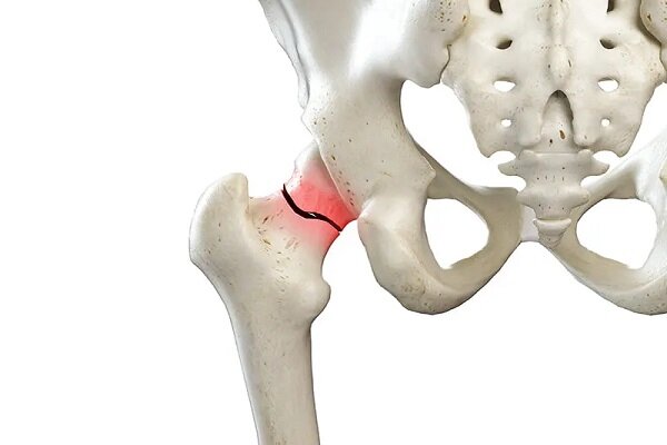 نداشتن تغذیه مناسب از علل شکستگی استخوان لگن است