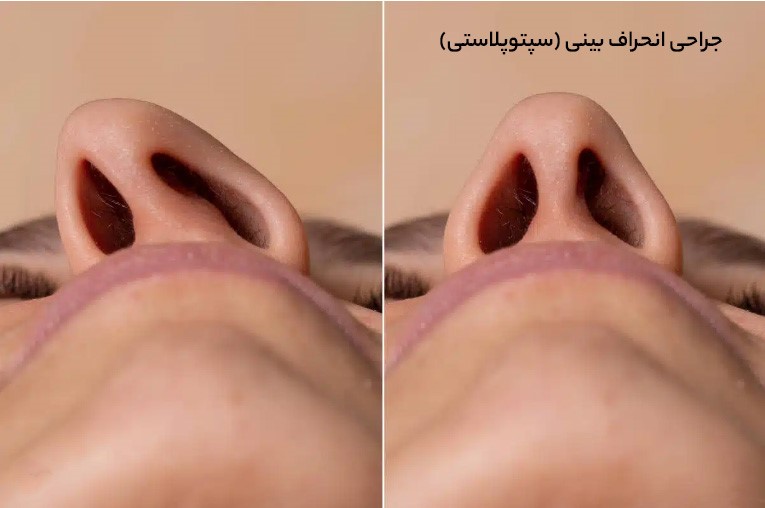 جراحی انحراف بینی سپتوپلاستی
